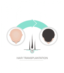 HairMD Transplant Clinical Advanced Series Producs